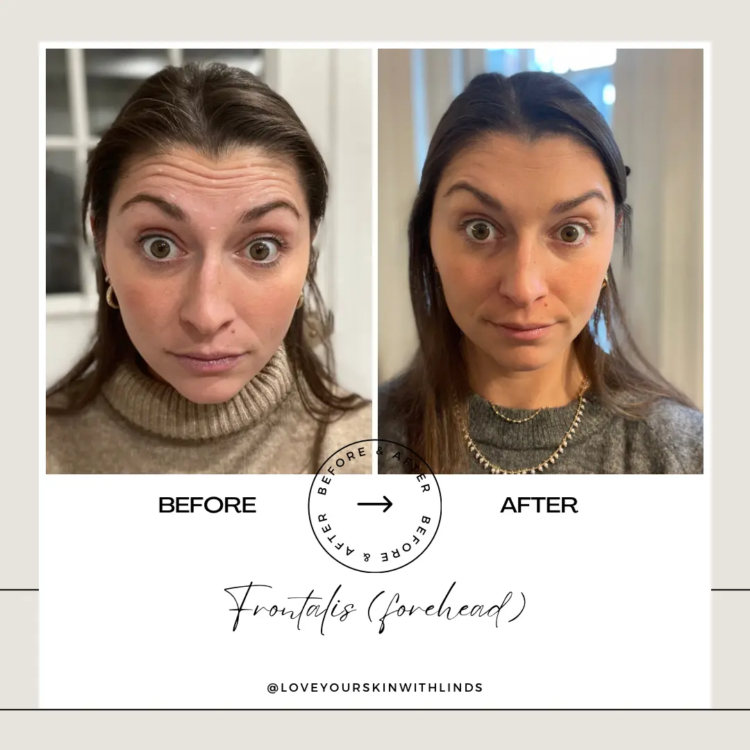 botox-fronatlis-forehead-loveyourskin-boston-ma