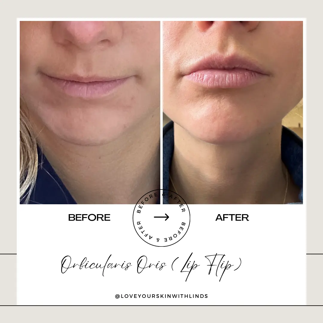 botox-lips-loveyourskin-boston-ma