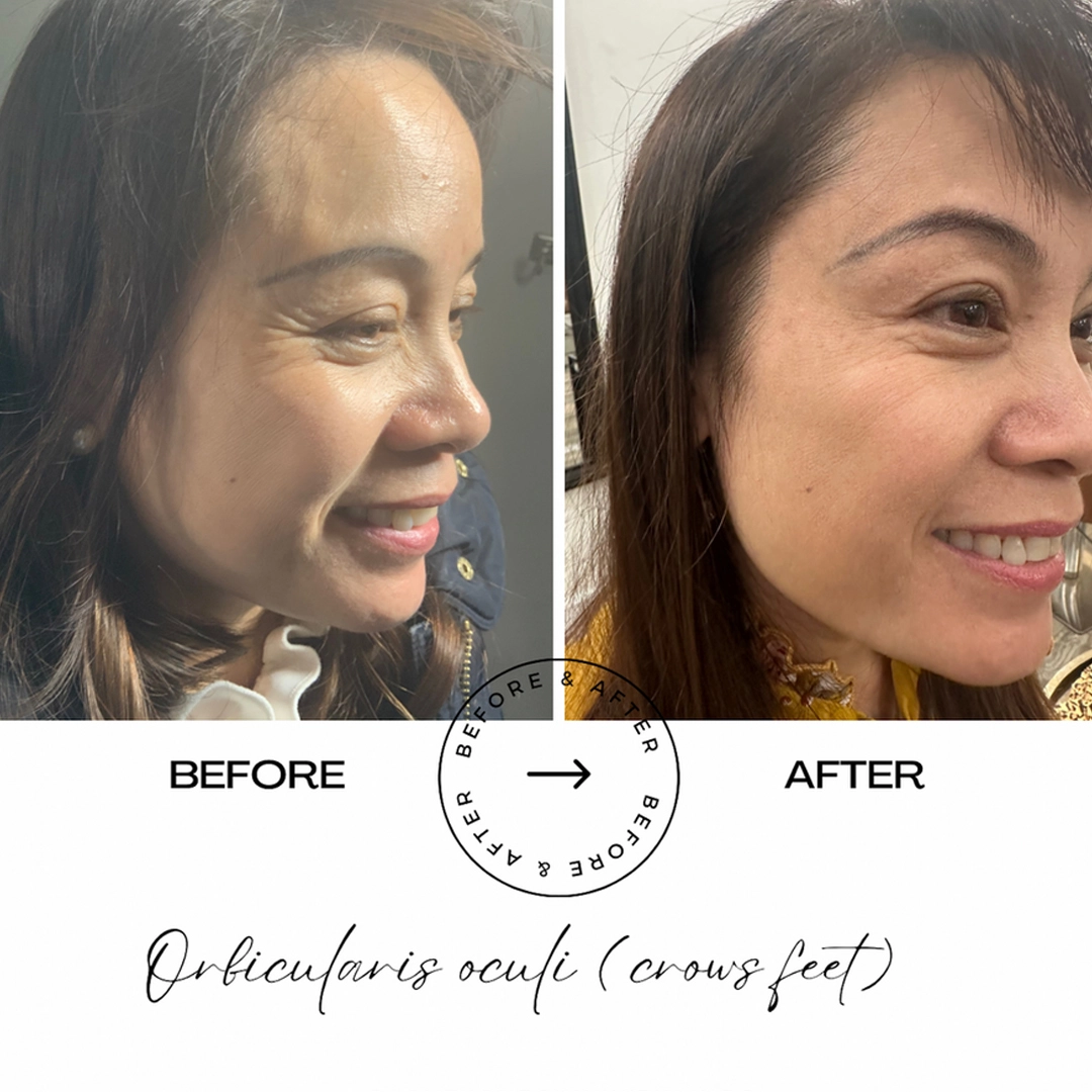 bottoxx-before-after-loveyourskin-boston-ma