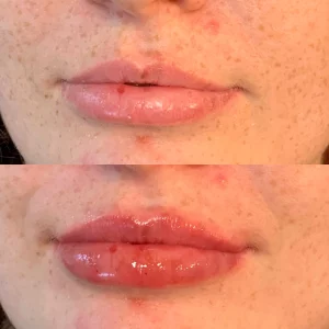 dermal-a-before-after-loveyourskin-boston-ma