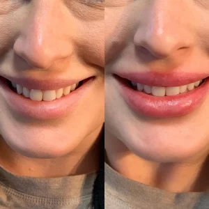 dermal-filer-e-before-after-loveyourskin-boston-ma