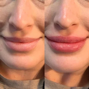 dermal-filler-bbefore-after-loveyourskin-boston-ma