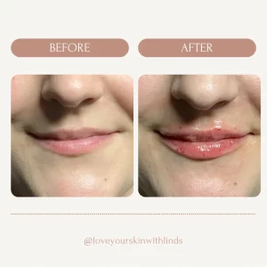 dermal-filler-before-after-loveyourskin-boston-ma