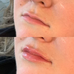 dermal-filler-c-before-after-loveyourskin-boston-ma