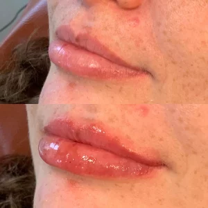 dermal-filler-d-before-after-loveyourskin-boston-ma