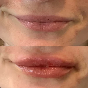 dermal-filler-f-before-after-loveyourskin-boston-ma