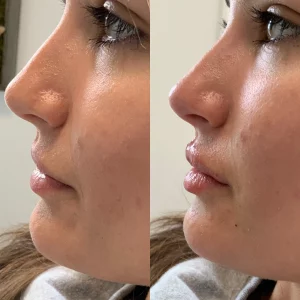 dermal-filler-g-before-after-loveyourskin-boston-ma