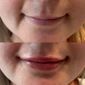 dermal-filler-i-before-after-loveyourskin-boston-ma