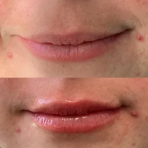 dermal-filler-j-before-after-loveyourskin-boston-ma