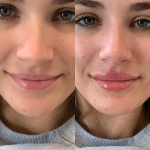 dermal-filler-k-before-after-loveyourskin-boston-ma