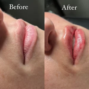 dermal-filler-l-before-after-loveyourskin-boston-ma