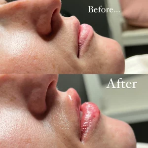 dermal-filler-m-before-after-loveyourskin-boston-ma