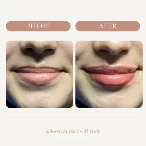 dermal-fillers-lip-before-after-loveyourskin-boston-ma