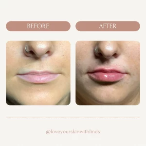 dermal-fillers-lipp-before-after-loveyourskin-boston-ma