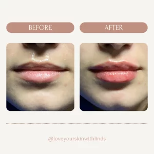 dermal-fillers-lips-before-after-loveyourskin-boston-ma