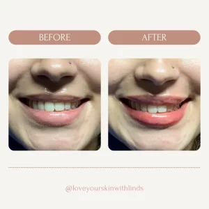 dermal-fillers-teeth-before-after-loveyourskin-boston-ma