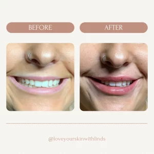 dermal-fillers-teeths-before-after-loveyourskin-boston-ma