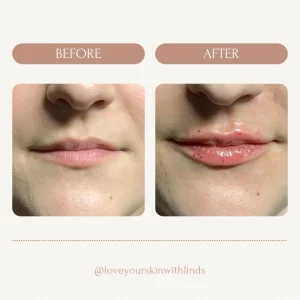 dermal-fillerss-before-after-loveyourskin-boston-ma