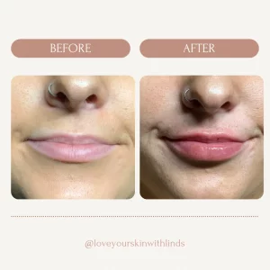 dermal-fillerss-lipp-before-after-loveyourskin-boston-ma