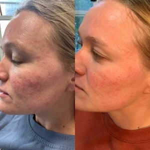 microneeding-c-before-after-loveyourskin-boston-ma