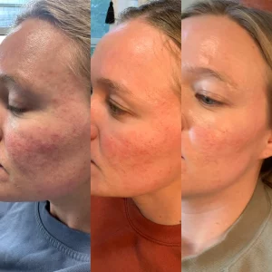 microneeding-f-before-after-loveyourskin-boston-ma